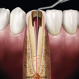 Hu-Friedy - GP1 Single End Root Canal Spreader - GP1 Black Line Smooth Handle